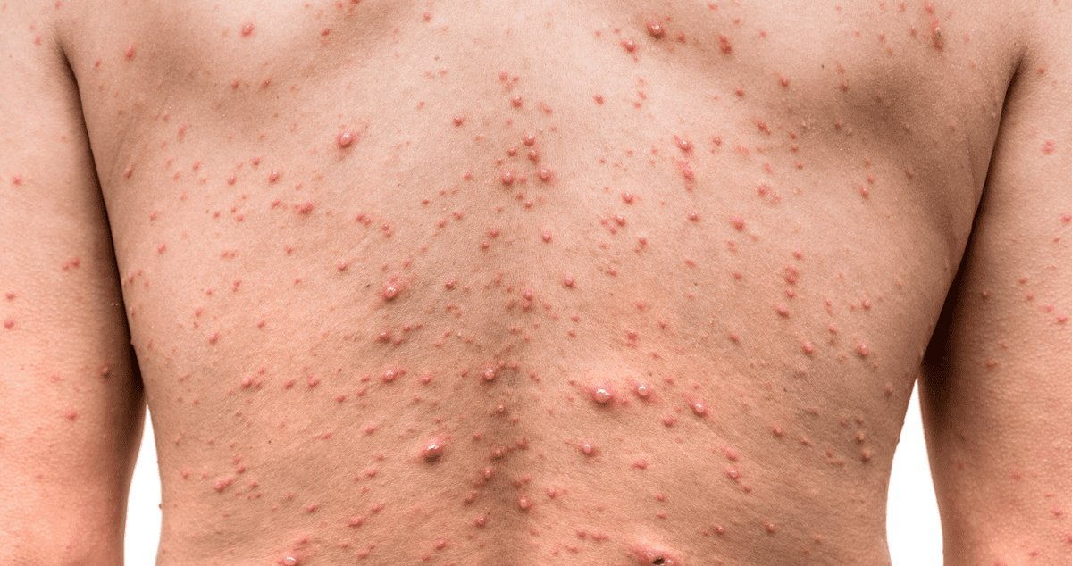 Brote de viruela del mono en Galicia: Nueve casos confirmados sin origen claro