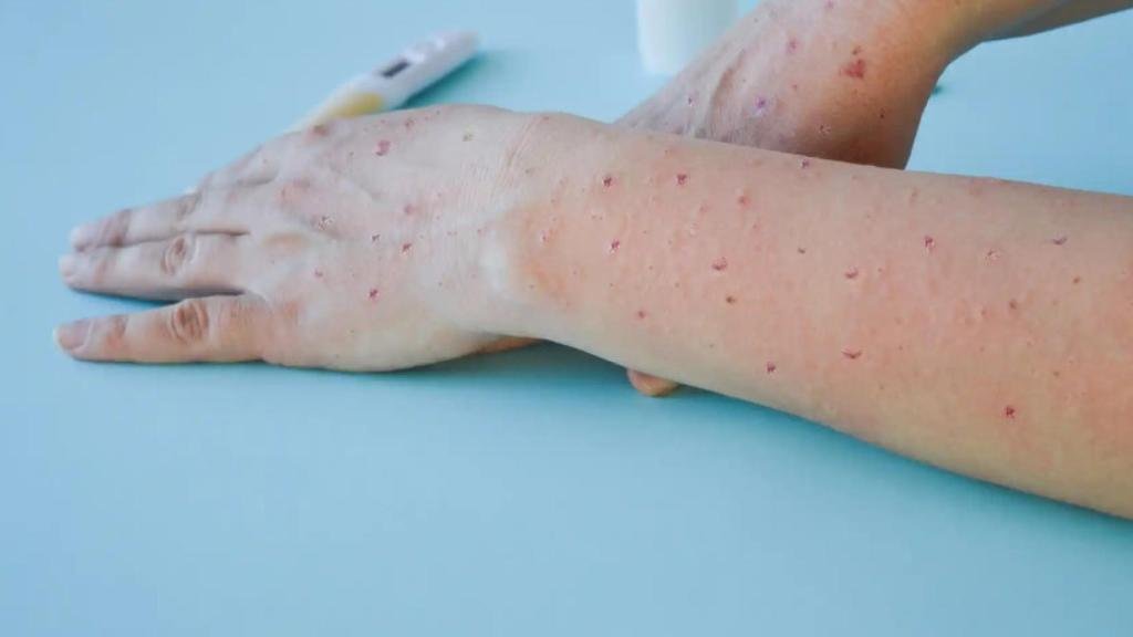 Brote de viruela del mono en Galicia: Nueve casos confirmados sin origen claro