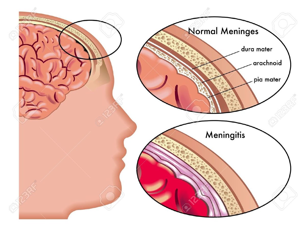 Meningite a Napoli: Allarme o Precauzione? Fatti e Chiarimenti sul Focolaio a Chiaia