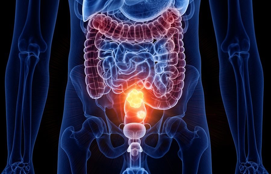 Tumore al Colon-Retto: Numeri, Prevenzione e Prospettive in Italia